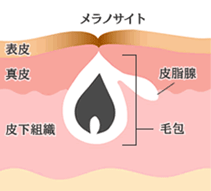 ニキビ痕
