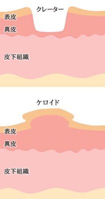 クレーター状の凸凹