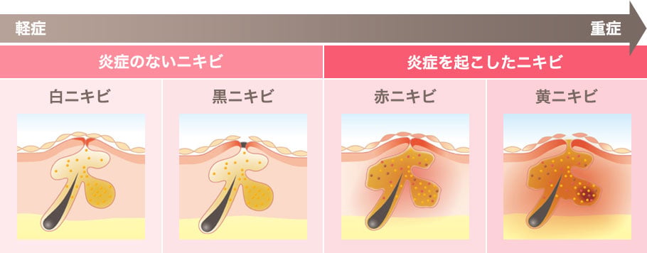 白ニキビ 黒ニキビ 赤ニキビ 黄ニキビ
