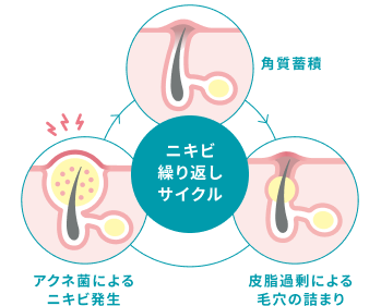ニキビ繰り返しのサイクル　イメージ画像